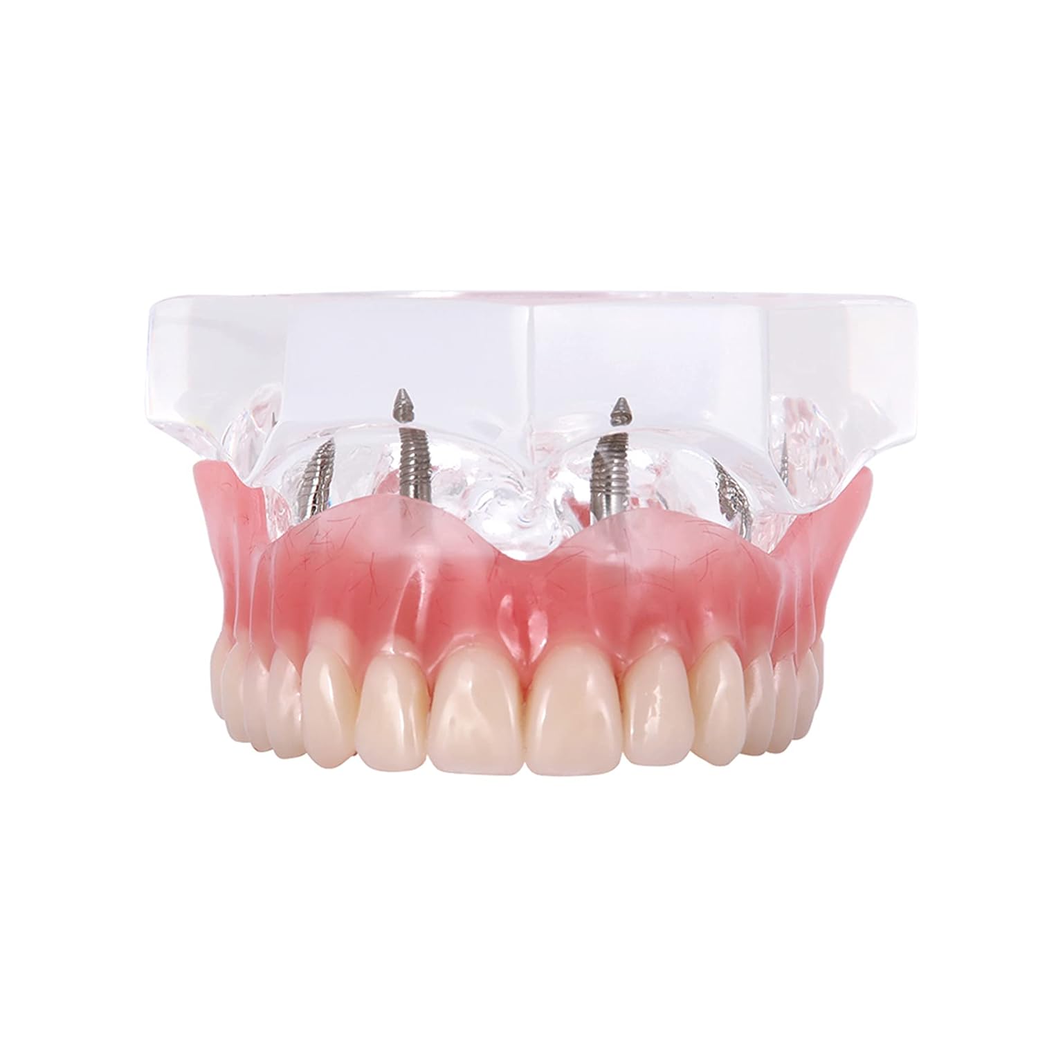 Fast-Fit Full Denture