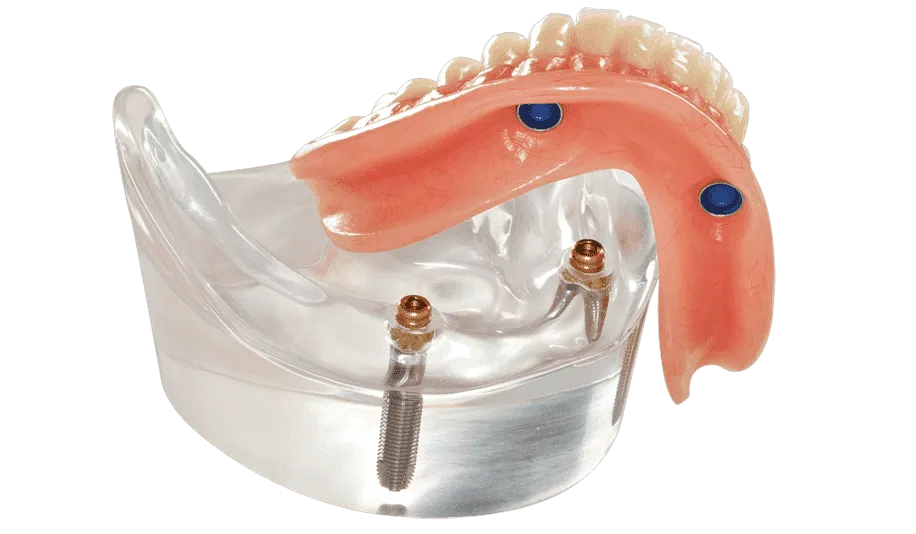 Fast-Fit Full Denture