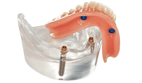 Fast-Fit Full Denture
